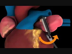 AtriClip® | Posicionamento do clipe