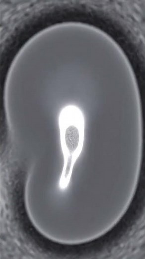 Breast Intramammary Node