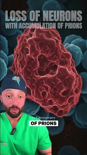 Here is how mad cow disease (bovine spongiform encephalopathy) looks like in a human. #medical