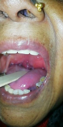 Tonsillitis and Peritonsillar Abscess