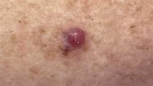 Signs of deadly skin cancer after doctor shares video of 'worst’ he's ever seen