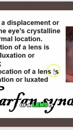 Marfan Syndrome: Lens Dislocation & Blue Sclera Explained #shorts