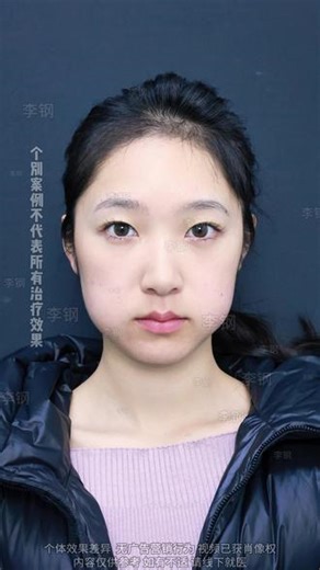 大方脸 咬肌肥大70天改善反馈 #下颌角长曲线 #下颌角 #咬肌肥大 #方脸 #变美思路学起来