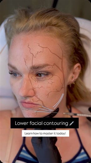 Derma Medical on Instagram: "If you’re still guessing where jawline and chin filler should go… this is for you. Jawline + chin shadowing isn’t about adding volume. It’s about structure, placement and control. Watch this video until the end to see correct placement in action. Want to master lower-face contouring properly? Learn landmark-led techniques, depth, planes and product choice on our Facial Contouring Masterclass at Derma Medical. DM us “CONTOUR” to find out more about our courses we’ll g