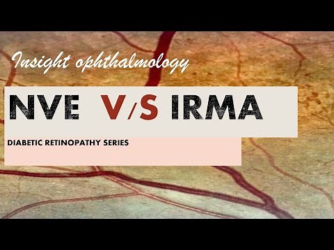 IRMA vs NVE || intraretinal microvascular abnormality vs neovascularisation