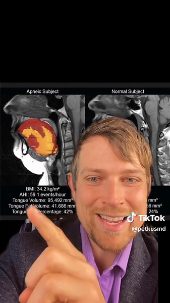 Understanding Sleep Apnea Beyond Weight Issues