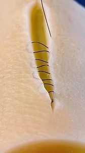 248K views · 1.4K reactions | Take a close look at this suture...