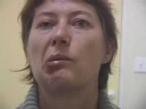 Paralysie faciale périphérique