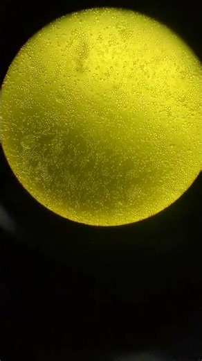 Filed full pus cells urine sample under microscope