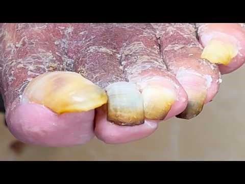 Super Long Toenails Waiting To Be Trimmed Wonderful Pedicure Video【Podiatry Clinic】