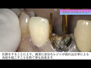 メタルコア除去〜感染根管処置