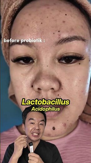 Can probiotics help acne?
