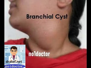 Branchial cyst /Sinus/Fistula/Neck Mass/ Lymph Nodes/Congenital Anomalies/Anatomy/Neck triangles