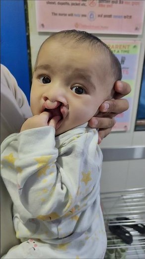 Best Bilateral Cleft Lip Surgery in India | Before and After Result by Dr Parit Ladani
