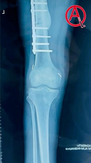 ACL, PCL Reconstruction & MCL Repair Arthroscopic Surgery