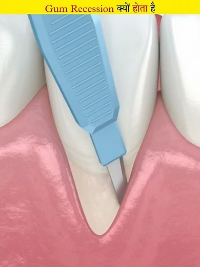 This is how gum recession is treated