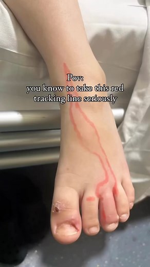 Lidia Molinara|Health Protection Awareness|Family Wellness on Instagram: "Parents, this isn’t just any mark—it’s called Lymphangitis. This redness in the skin line is a signal that an infection is spreading through the lymphatic system. If you ever see this, it’s time to act fast. It’s serious, but when caught early, antibiotics can fix it. If left untreated, though, it can turn into sepsis, a life-threatening condition. Don’t ignore this red flag! (P.S. the really prominent red lines are red ma