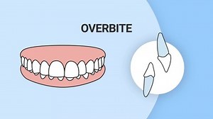Malocclusion Overbite. Dental problem. 3d illustration. Dental care concept.