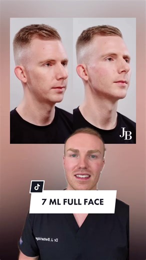 Jawline, Cheek, and Chin Dermal Filler Transformation | Before & After Photos