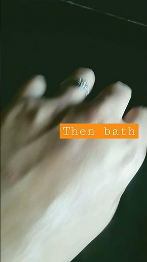 Grover disease home treatment