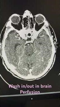 CT perfusion #radio #shortsfeed #trending #shortvideo