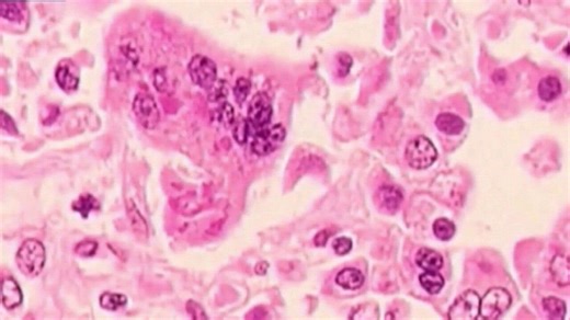 Measles case confirmed in Coconino County