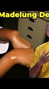 Madelung Deformity Explained: Causes, Symptoms, and Treatment | Understanding Wrist Deformities