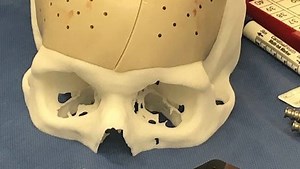 Imagine: New era of medicine marked by surgically implanted 3D printed skull