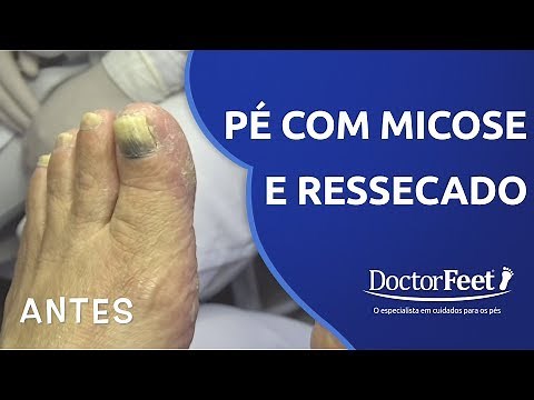 Podologia em pé com MICOSE e RESSECADO (antes e depois)