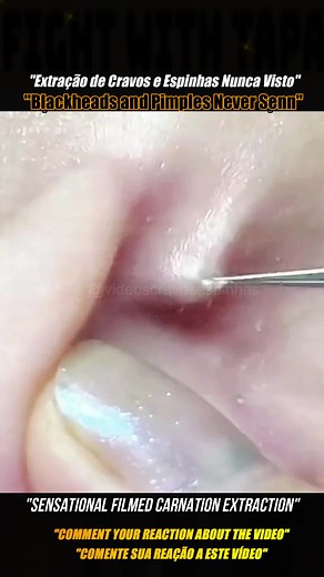 #pimplepopper2022 #removal #pimplepopper #skincare #cystpopping #acne #pimplepop #pimple #fyp #tiktok #pimplepopper2021