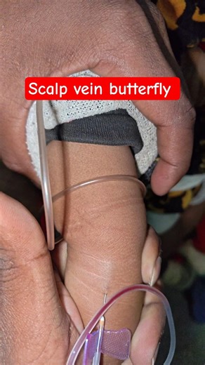 Scalp Vein Butterfly Needle Insertion Technique #nursing #practice #medical #shorts #ytshorts #viral