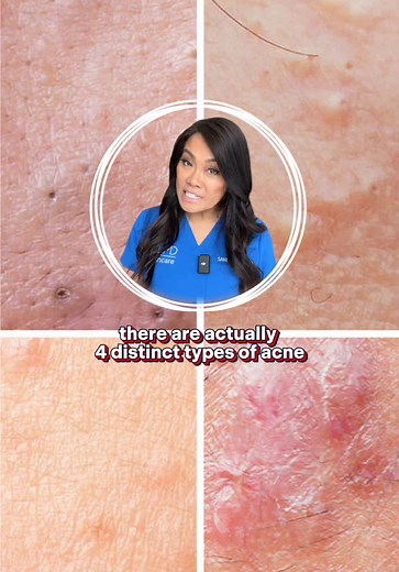 Understanding the Four Types of Acne in Dermatology