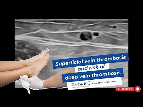 Superficial vein thrombosis and risk of deep vein thrombosis