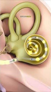 How Cochlear Implants Work 🇱🇷 Restoring the Sense of Sound