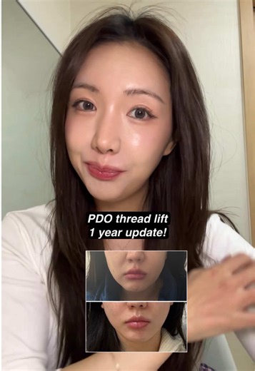 1 Year Update on PDO Thread Lift Results