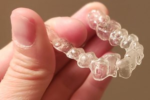 Invisalign Trays Cracking: Patient Experiences, and What to Do - Dental Health Society