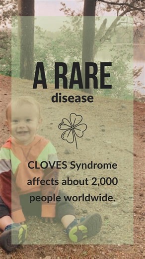 What is CLOVES Syndrome? CLOVES is an acronym for the list of common features associated with this ultra-rare, non-hereditary genetic syndrome: 🍀 Congenital 🍀 Lipomatous 🍀 Overgrowth 🍀 Vascular anomalies 🍀 Epidermal nevi 🍀 Scoliosis and/or Skeletal anomalies CLOVES Syndrome is the result of a mutation in the PIK3CA gene that occurred in utero. Because of this, it falls under an umbrella of conditions called PROS (PIK3CA Related Overgrowth Spectrum) There are very limited treatment options 