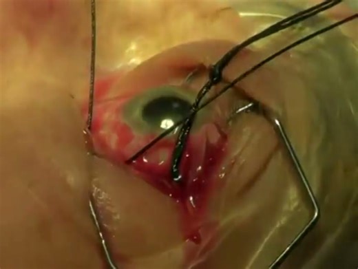 Segmental Scleral Buckle For Retinal Detachment