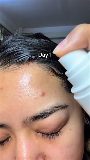 Effective Treatment for Cystic Acne