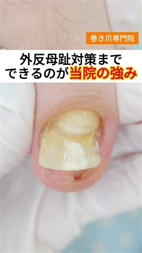 外反母趾が巻き爪の原因