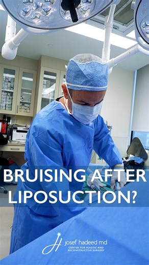 Josef Hadeed on Instagram: "Bruising or swelling down there after lipo? You’re not alone. One of the most common (and surprising) post-op questions we get is about genital swelling after surgery. And yes, it’s totally normal. 📱 DM us for more information 📞 For scheduling, please call (310) 970-2940 💻 www.josefhadeedmd.com/ . . . #drhadeed #josefhadeedmd #consultation #plasticsurgery #plasticsurgeon #beverlyhills #LA #california #Miami #Florida #waistline #snatched #bodycontouring #results #li