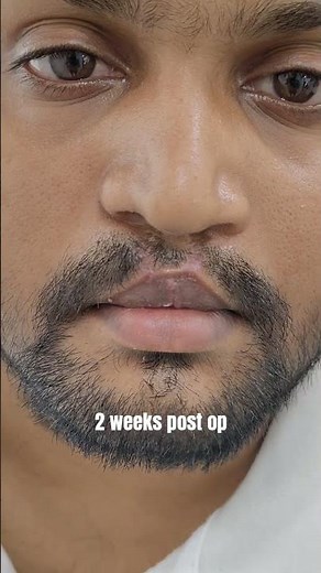 Removing Sutures after Secondary Lip Repair Surgery in Adult Patient | Dr Parit Ladani
