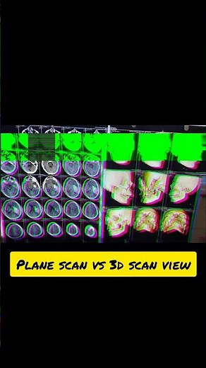 "Plan CT vs 3D View"#subscribemychannel #viral