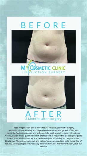 Stomach Liposuction Sydney Before & After Photos