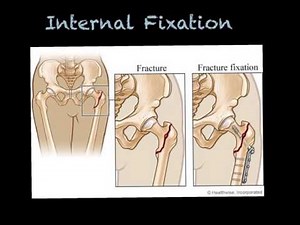 external and internal fixation