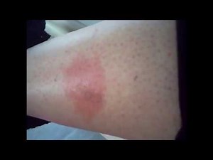 soigner naturellement une piqûre d insecte