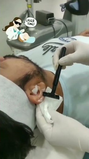 Ear Lobe Laser Hair Removal Procedure