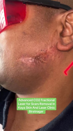 Advanced CO2 Fractional Laser Treatment in Biratnagar
