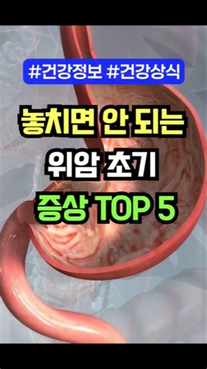 놓치면 안되는 위암 초기 증상 TOP5 #건강습관 #건강상식 #건강관리 #건강뉴스 #건강정보 #50대건강관리 #50대건강 #중년건강 #위암증상 #위암