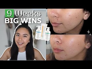 2 Month Update MAJOR IMPROVEMENT: ACNE.ORG Skin Journey